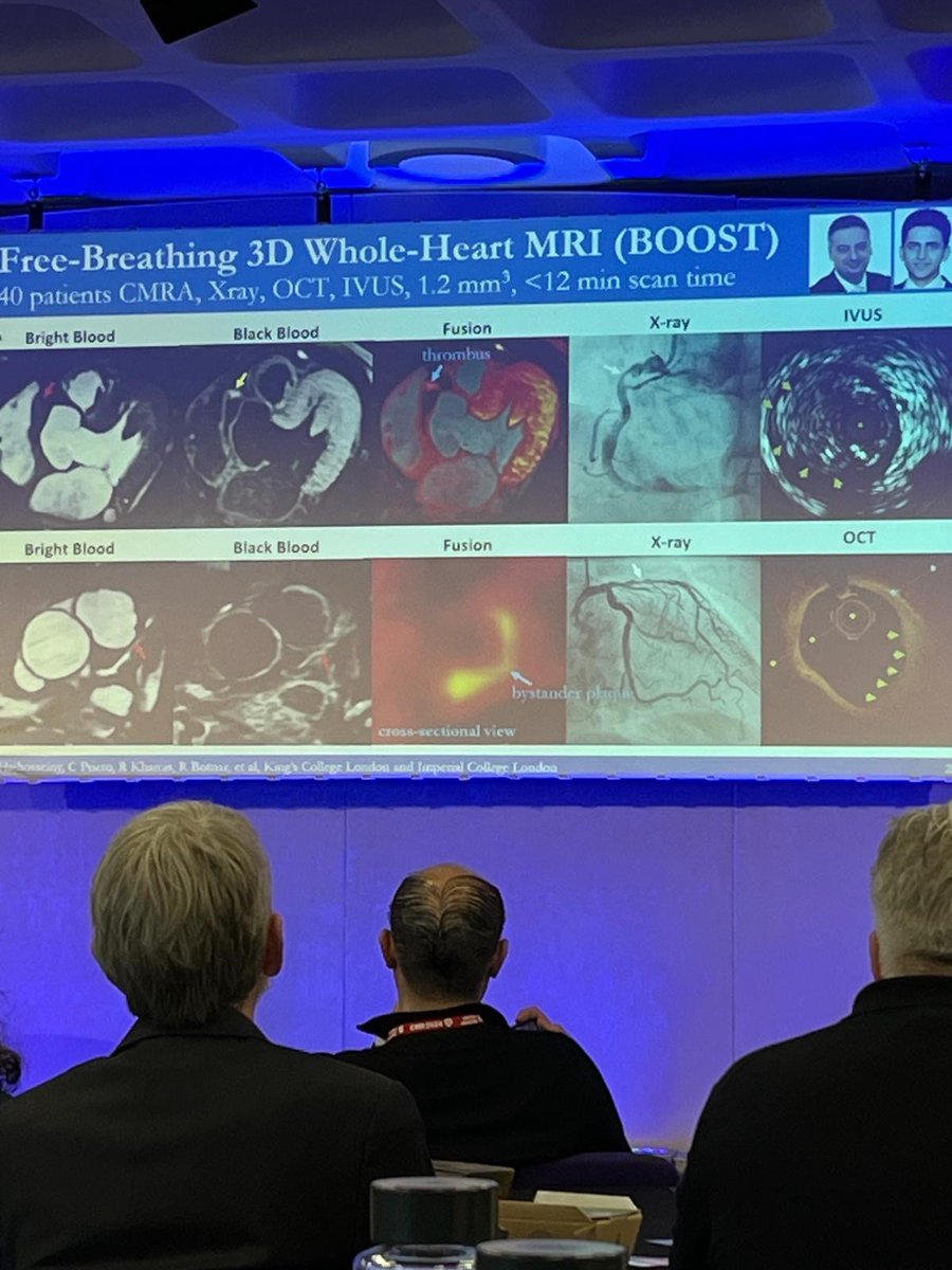 Reza Hajhosseiny (@rezahajhosseiny) on Twitter photo Prof René Botnar showcasing 3D free breathing whole-heart CMRA and plaque imaging at SCMR. <a href="/SCMRorg/">Society for Cardiovascular Magnetic Resonance</a> <a href="/rbotnar/">Rene Botnar</a> <a href="/rkhamis/">Ramzi Khamis</a> <a href="/DrAdamHartley/">Adam Hartley</a> <a href="/MRI_CPrieto/">Claudia Prieto</a> #CMR2024 #whyCMR Prof René Botnar showcasing 3D free breathing whole-heart CMRA and plaque imaging at SCMR. <a href="/SCMRorg/">Society for Cardiovascular Magnetic Resonance</a> <a href="/rbotnar/">Rene Botnar</a> <a href="/rkhamis/">Ramzi Khamis</a> <a href="/DrAdamHartley/">Adam Hartley</a> <a href="/MRI_CPrieto/">Claudia Prieto</a> #CMR2024 #whyCMR