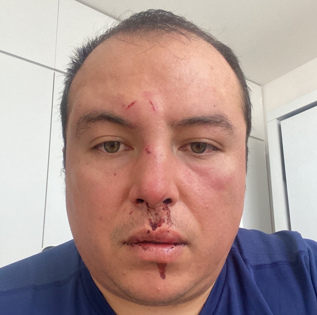 🚨 El Señor que fue Golpeado cuando caminaba con su perro por los Guaruras de <a href="/SandraCuevas_/">Sandra Cuevas</a> es @robernoricumbo 

Tiene lesiones en la cabeza y los médicos le pidieron una tomografía por posible daño interno. 

Dice que tiene más evidencias y que quiere ponerse en contacto con la