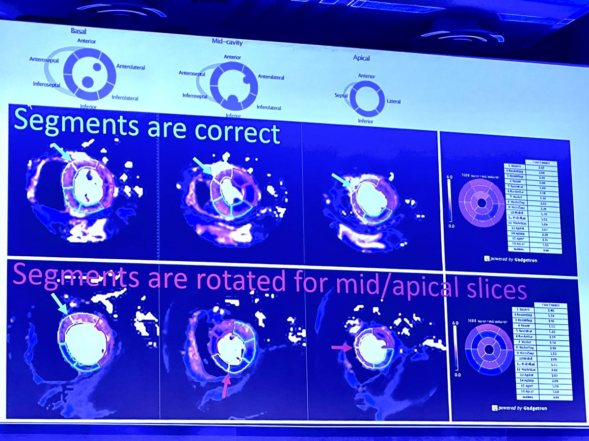 Quantitative perfusion tips and tricks from the master Peter Kellman #CMR2024