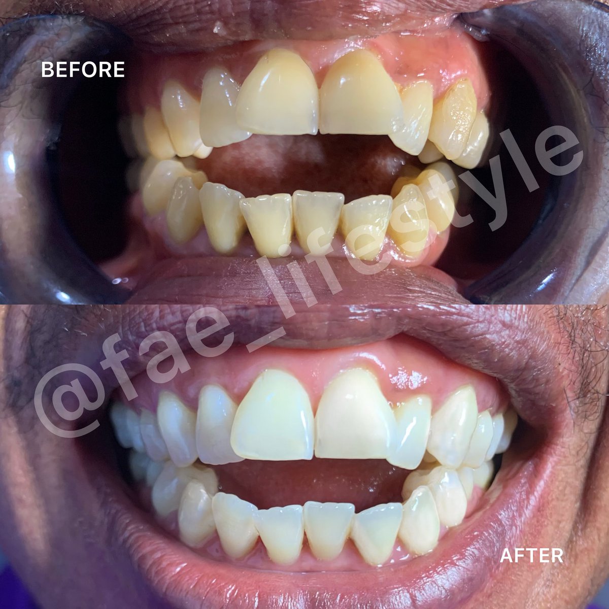 FaeLifestyle's tweet photo. Results we love to see! 🥰 Our client here did scaling and polishing, teeth whitening.

PRICE: 1 hour package #40,000 Naira, 1 hour 30mins package #60,000 Naira

Scaling and polishing Range from 30k to 50k
#dentalcare #scaling #teethwhitening #laser https://t.co/NWBcVyJZkQ