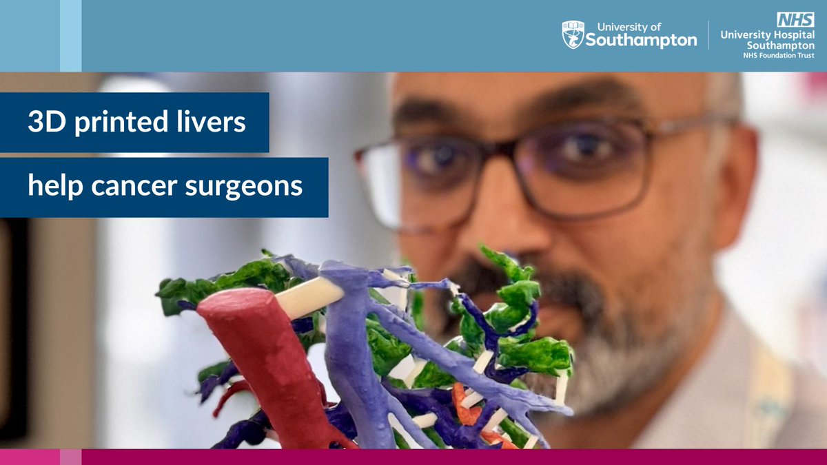 Surgeons in Southampton are the first in the UK use 3D printed livers to treat patients with bile duct cancer. 🏥 The research is led by Arjun Takhar, @UHSFT consultant hepatobiliary and pancreatic cancer surgeon, and supported by @PLANETSCHARITY. 👇 research.uhs.nhs.uk/news/3d-printe…