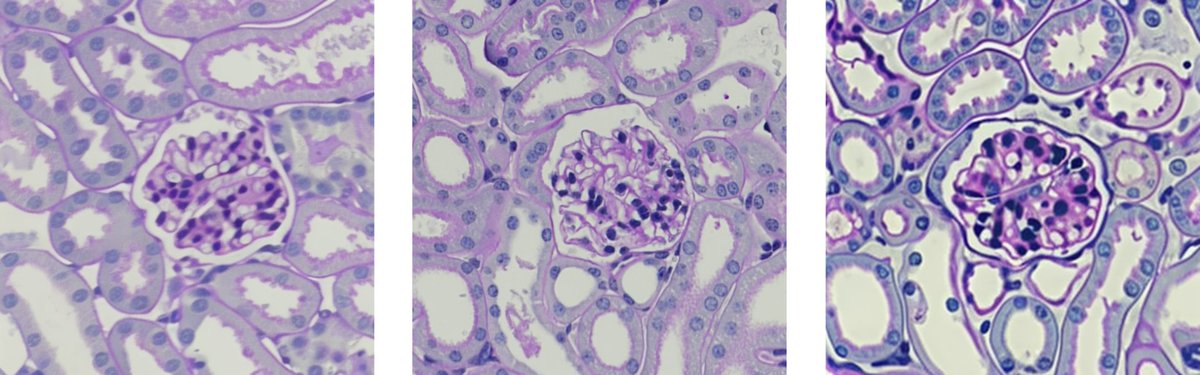 _JanHartung_'s tweet photo. Can you tell apart real from fabricated histological images?    

Preprint from @uniklinik_jena, @ChariteBerlin
&amp; @UniFreiburg on the difficulty to identify "scientific" images fabricated using generative algorithms. #ImageForensics 

https://t.co/TUKyVXQzyF

(Solution below 🧵) https://t.co/aUuG3SzDhq