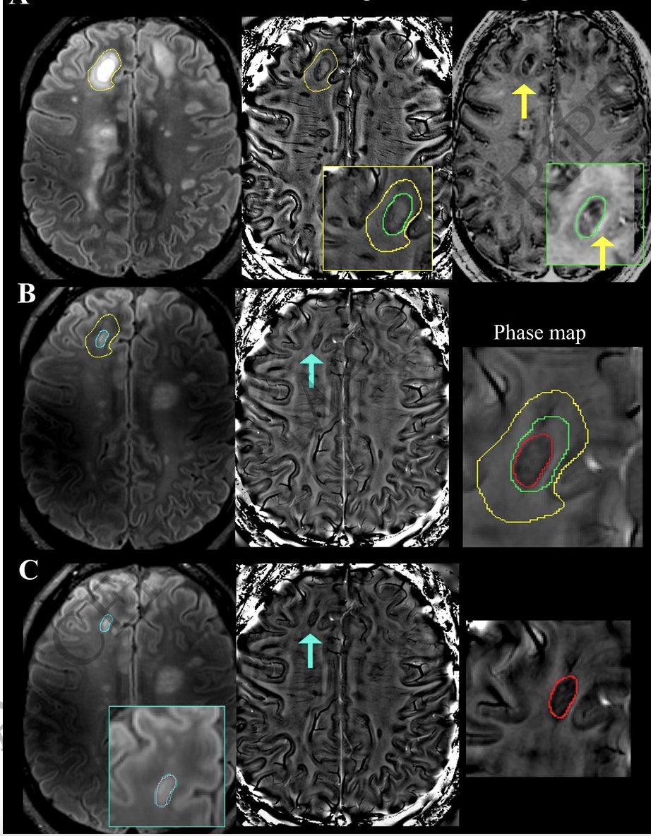 IJMSC (@ijmsctweets) on Twitter photo "Paramagnetic rim lesions=#biomarker with most robust histopathologic substantiation. Here, we propose standardized approach to identify #PRL in context of non-GBCA-enhancing, sharply demarcated T2-lesions as well as larger confluent lesions."
<a href="/BagnatoLab/">Francesca Bagnato and the NeuroImaging Unit</a> academic.oup.com/brain/article/… "Paramagnetic rim lesions=#biomarker with most robust histopathologic substantiation. Here, we propose standardized approach to identify #PRL in context of non-GBCA-enhancing, sharply demarcated T2-lesions as well as larger confluent lesions."
<a href="/BagnatoLab/">Francesca Bagnato and the NeuroImaging Unit</a> academic.oup.com/brain/article/…