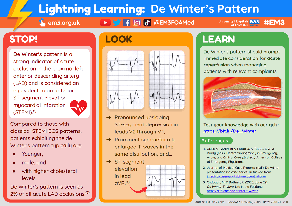 EM3FOAMed's tweet photo. Following up on this week's quiz on ECGs not to miss: we've got a brand new #LightningLearning about de Winter's pattern ๐ Similar to classical STEMI patterns, these patients could easily be overlooked! https://t.co/B7L47IVj6f