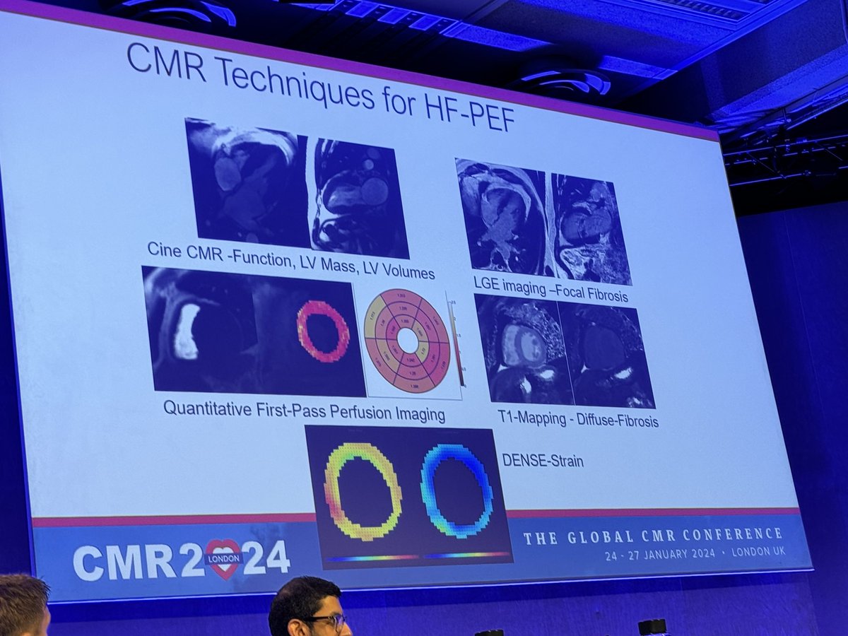 Patricia Rodriguez Lozano MD, MS (@prodriguezmd) on Twitter photo Absolutely fantastic talk on The Role of Quantitative Perfusion in NICM by my mentor and friend <a href="/salernomdphd/">Dr. Michael Salerno M.D. P.h.D</a>
šperfusion abnormalities in NICM are driven by microvascular dysfunction and typically show global reduction in MBF and MPR often worse in the subendocardium #CMR2024 Absolutely fantastic talk on The Role of Quantitative Perfusion in NICM by my mentor and friend <a href="/salernomdphd/">Dr. Michael Salerno M.D. P.h.D</a>
šperfusion abnormalities in NICM are driven by microvascular dysfunction and typically show global reduction in MBF and MPR often worse in the subendocardium #CMR2024