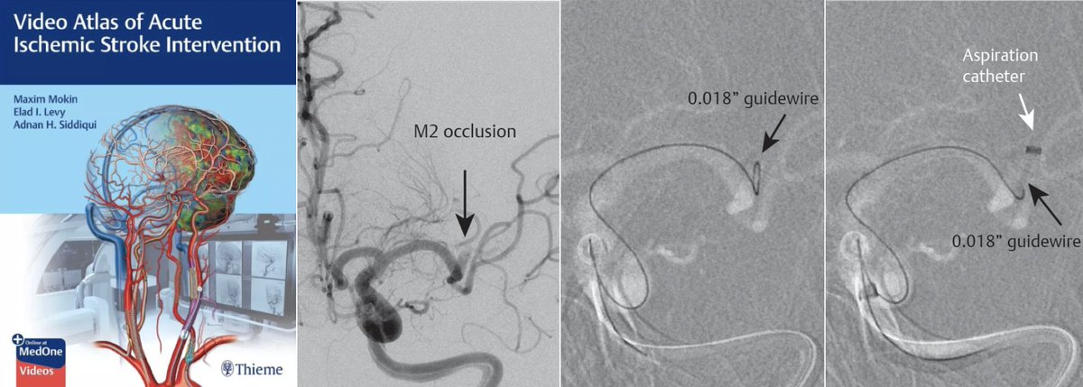 Tips for successful aspiration from the 🦬 'Video Atlas of Acute Ischemic Stroke Intervention', Chapter 10 by @ThiemeIntl @_AdnanSiddiqui @EladLevyMD 📖 Optimize delivery of aspiration catheter using a larger “J”-shaped 0.018-inch wire (=safe and effective)