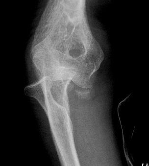 traumaticum's tweet photo. What kind of elbow dislocation is this? what are your dynamic mechanical concerns, and what will you assess and fix in what order (and how!), to regain stability? more CT slices below 😀

#iloveelbows
#orthotwitter 
@Gnomelover1970 @drrogervanriet @itius @robgraymd https://t.co/chTcBfvDo2