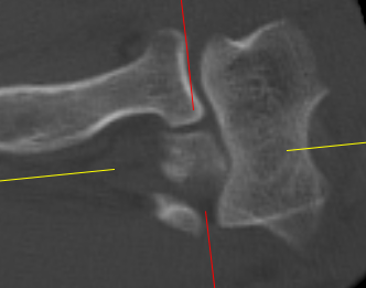 traumaticum's tweet photo. What kind of elbow dislocation is this? what are your dynamic mechanical concerns, and what will you assess and fix in what order (and how!), to regain stability? more CT slices below 😀

#iloveelbows
#orthotwitter 
@Gnomelover1970 @drrogervanriet @itius @robgraymd https://t.co/chTcBfvDo2