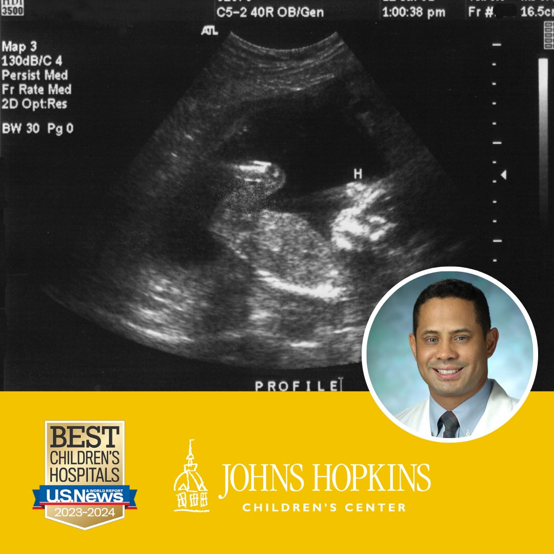 Ultrasound exams can identify the presence of life-threatening conditions. Hear more from pediatric surgeon @shaunkunisaki about the importance of minimally invasive and open fetal interventions. 🔗 bit.ly/42uNPAl #MedTwitter