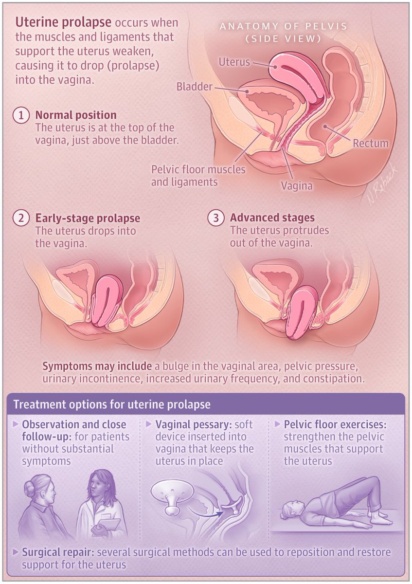 JAMA on X: Uterine prolapse occurs when the uterus drops into the vagina.  This JAMA Patient Page discusses diagnosis and treatment options for uterine  prolapse.   / X