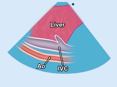 #POCUS illustration of the day:
IVC views
- Traditional subxiphoid long axis
- Subxiphoid bicaval view showing SVC in addition
- Subxiphoid transverse view showing IVC and aorta
- Lateral right upper quadrant view showing IVC and aorta
#MedEd #Nephrology #IMPOCUS 

Image courtesy