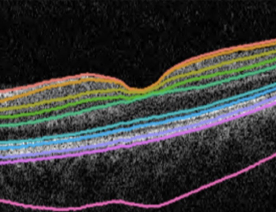 The thickness of the retina may help predict the risk of various eye, neuropsychiatric, and cardiometabolic disorders, shows a new phenotypic and genotypic analysis of retinal #OCT images from members of <a href="/uk_biobank/">UK Biobank</a>. <a href="/MassEyeAndEar/">Mass Eye and Ear</a> <a href="/DrZebardast/">DrZebardast</a> <a href="/zekavatm/">Maryam Zekavat</a> scim.ag/5Fk