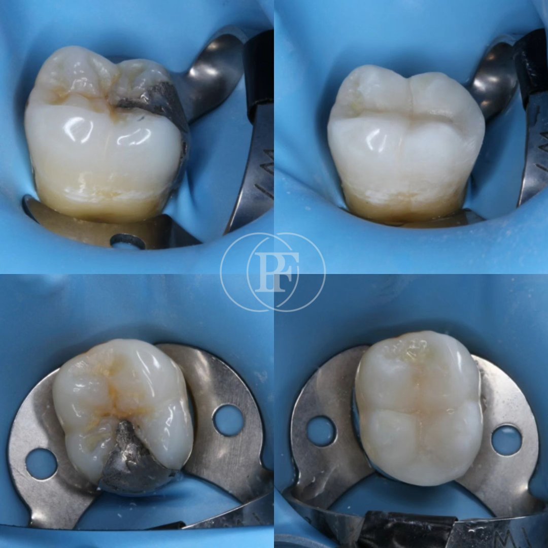 Composite restoration by dental therapist Sophie 🤍

Check out more of our team's work: painfreedentistrygroup.co.uk/smile-gallery/

#dentistry #painfreedentistry #beforeafter #glasgow #dentaltherapist