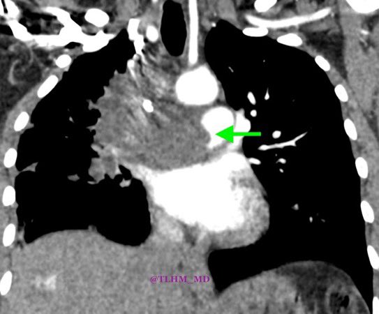 #Chestrad - Pulmonary Artery Sarcoma

- rare, more common in women
- pro tip: look for low-density lesion filling entire pulmonary artery lumen, expansion of the involved arteries +/- extraluminal tumor extension
- mean survival: 12-18 months 

#radiology #FOAMRad