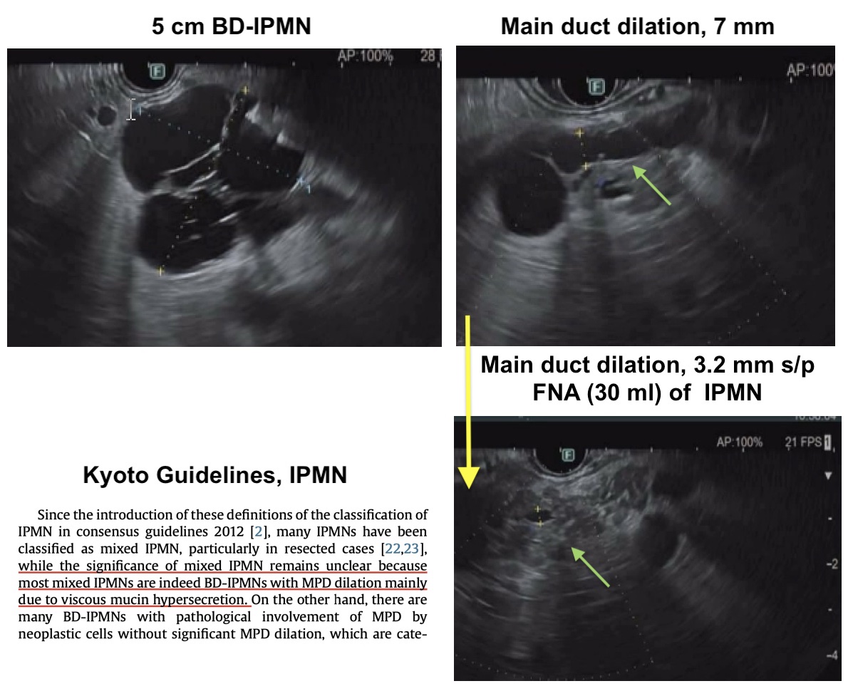 Not all dilated main PD in pts with BD-IPMN is 'mixed' IPMN. The updated evidence-based Kyoto guidelines acknowledge this. Case🔽 5 cm genu BD-IPMN with associated PD dilation; 7 mm ⏬ to 3 mm after FNA of IPMN (30ml fluid). 💡Mention this in your endo report @ASGEendoscopy