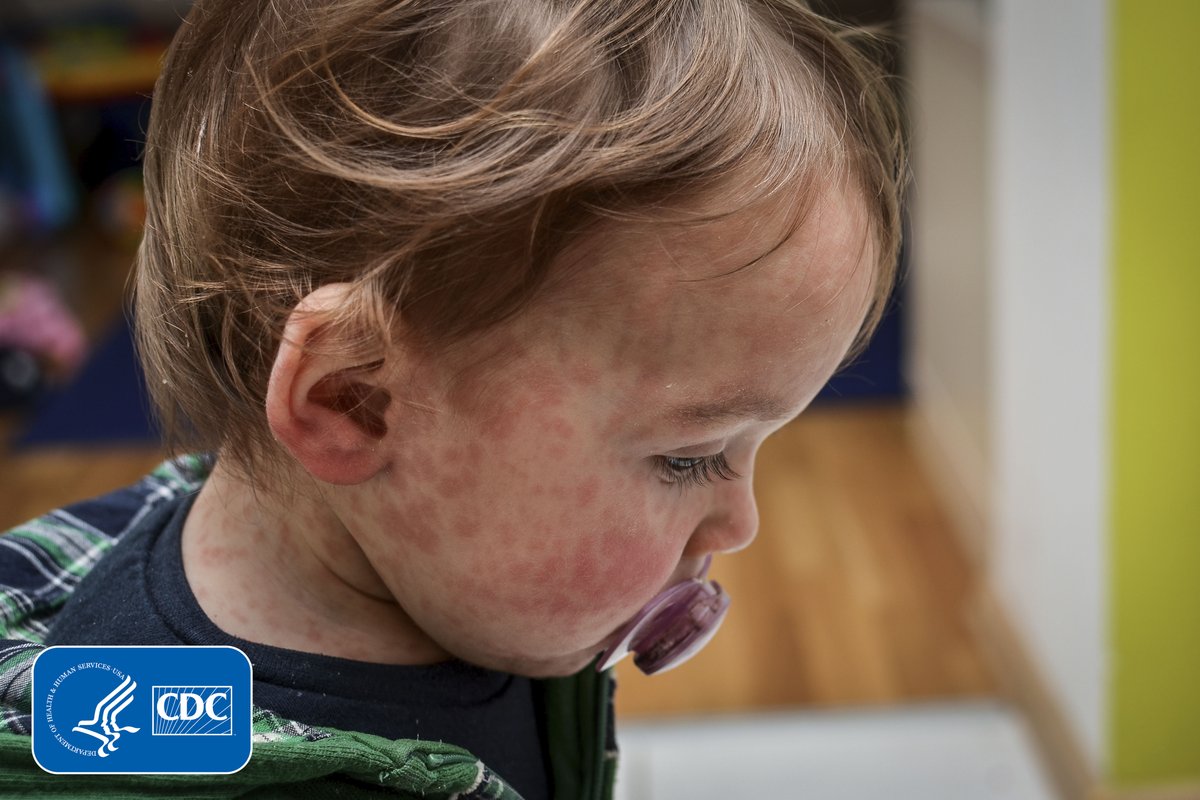 #HCPs: Stay alert for #measles cases. The top 5 recommendations include: 1️⃣ Isolate 2️⃣ Notify 3️⃣ Test 4️⃣ Manage 5️⃣ Vaccinate Explore the detailed recommendations for you and your practice: bit.ly/3vST54r