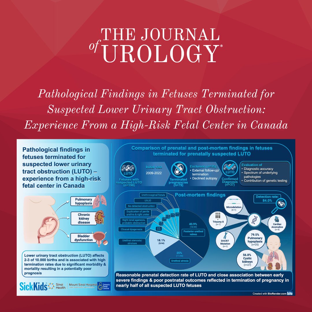 Read this amazing article from author @about__juliane 📰 Pathological Findings in Fetuses Terminated for Suspected Lower Urinary Tract Obstruction: Experience From a High-Risk Fetal Center in Canada Read the full article here ➡️ bit.ly/3UieMVA
