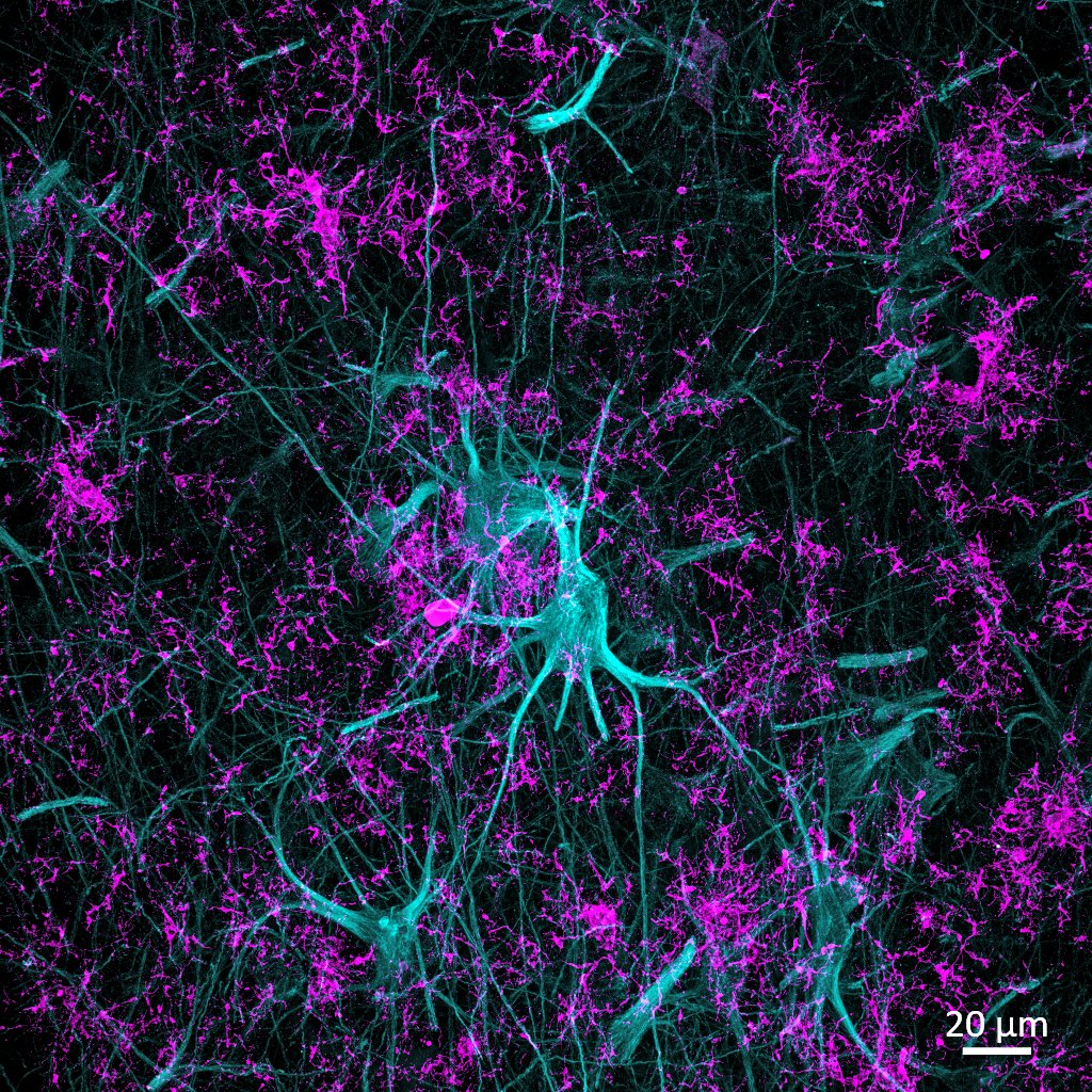 Real #FluorescenceFriday this time, with a fresh photo from the microscopy showing one of my favorite events in the brain: synaptic pruning! Microglia (🟣Iba1) strengthening circuits and removing redundant synapses from neurons (🔵map2): underdo it during development, and you…