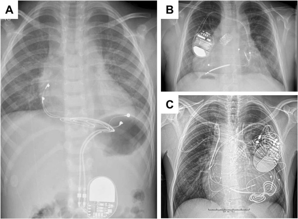 ZHeart11768530's tweet photo. 🔴 2024 SCMR expert consensus statement for cardiovascular magnetic resonance of patients with a cardiac implantable electronic device #openaccess
https://t.co/rXJrEijLh0
#CardioTwitter #CardioEd #cardiotwiteros #cardio #whymri https://t.co/G4Q0bCWQdW