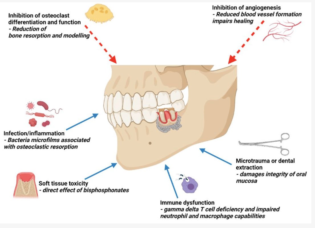 How I manage bone modifying agents (BMAs) in #myeloma to avoid jaw osteonecrosis: #mmsm 
- Obtain dental eval before starting BMAs
- If pending invasive dental procedure, advise holding BMAs  2-3 months before and after
- Dental exams every 6 months
Ref: mdpi.com/2072-6694/13/1…