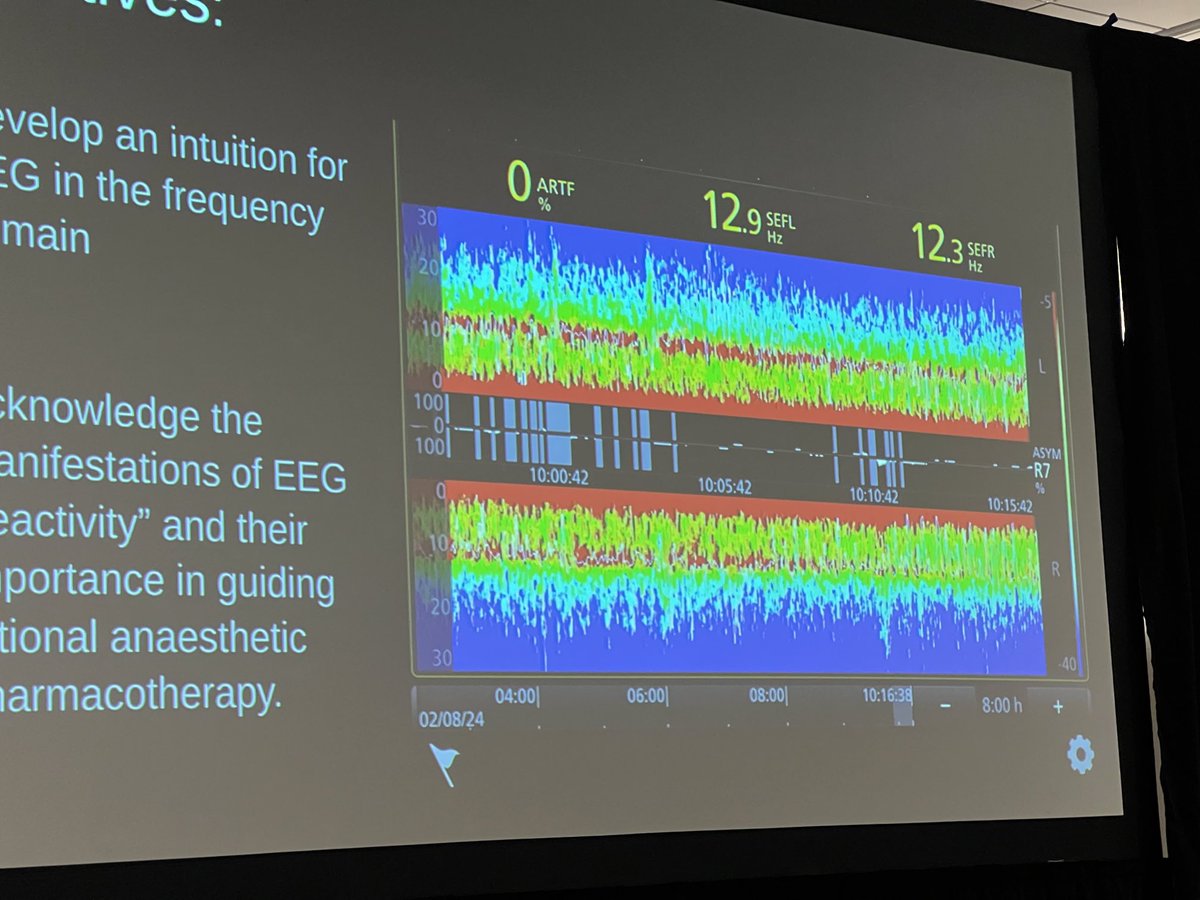LowUpCdnAnesSym's tweet photo. #LUCAS2024

⁦@BryanGlezerson⁩ 

EEG in Anesthesia: Rational Use in GA &amp; Sedation https://t.co/OAJxsXyra5