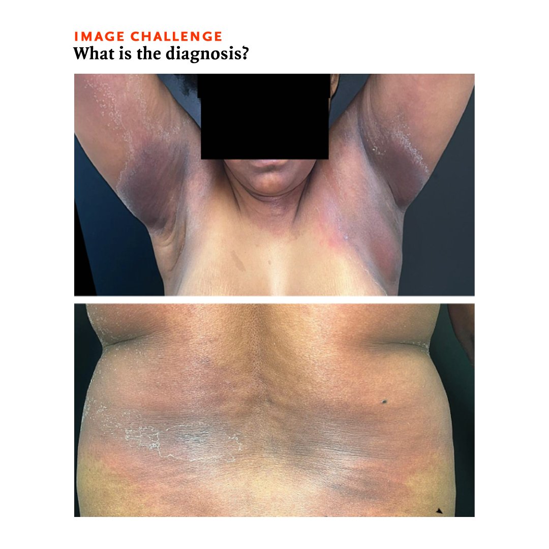 An otherwise healthy 42-year-old woman presented with a 10-day history of a rash in her axillae and on her groin and abdomen. 1/4