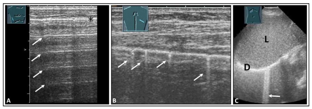 Lung Ultrasound and Pleural Artifacts: A Pictorial Review 

CCR Journal Watch
criticalcarereviews.com/latest-evidenc…

Get the latest critical care literature every weekend via the CCR Newsletter - subscribe at criticalcarereviews.com/newsletters/su…