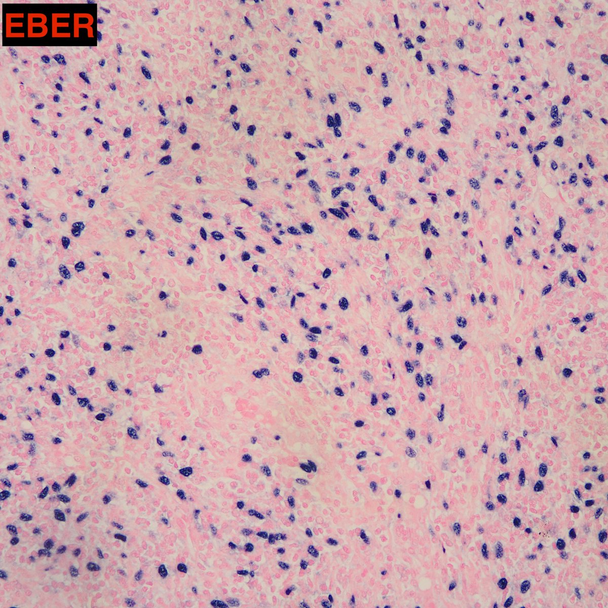 EBV-positive inflammatory follicular dendritic cell sarcoma, diagnosed in the liver. This is a relatively indolent histiocytic proliferation with FDC phenotype and consistent EBV positivity. Recognizing the rich lymphoplasmacytic background can aid in the diagnosis.