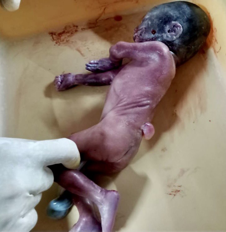 SocietyofFetMed's tweet photo. Answer 115: Check the Video and Images

Case credit: Dr. Hitanshu Bhatt &amp; Dr. Gouri Nagraj

Follow for more

#maternalmedicine #fetal #fetalmedicine #societyoffetalmedicine #fmf #fetomaternalmedicine #sfm
#isuog #diagnosis #medtwitter #fetalmed https://t.co/iVPeFRsQpK