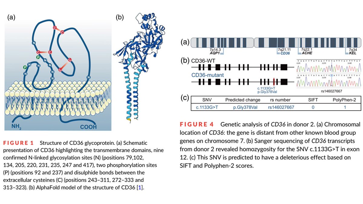 CzerwinsMarcin's tweet photo. Interesting paper explains why CD36 is a blood group antigen of clinical importance https://t.co/mqumsc3TB6

#blood_group https://t.co/CdZBHBUf62