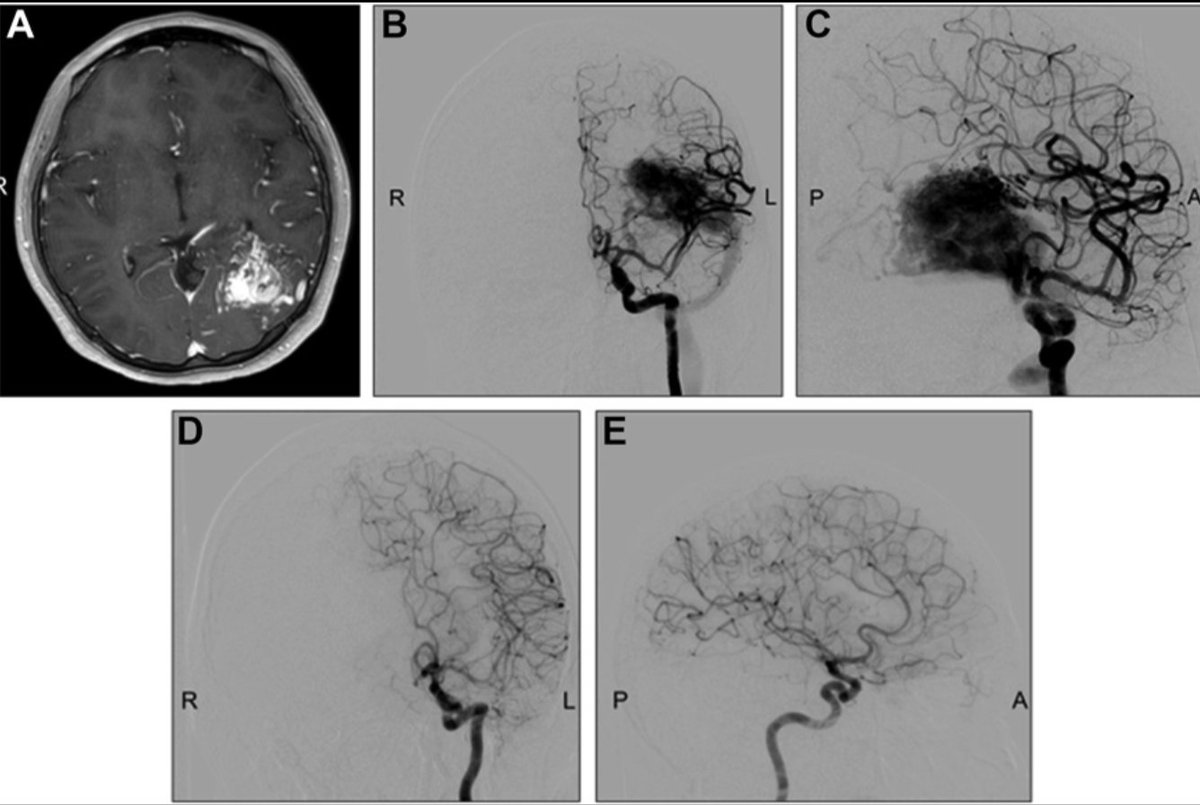 #NEUPrac Time-Dosed Stereotactic Radiosurgery for the Treatment of Cerebral Arteriovenous Malformations: An Early Institution Experience and Case Series bit.ly/4bd8cpD by Sethi et al bit.ly/4bd8cpD @CUMedicalSchool @jmascite @AliAlawiehmdphd @LKReedMD