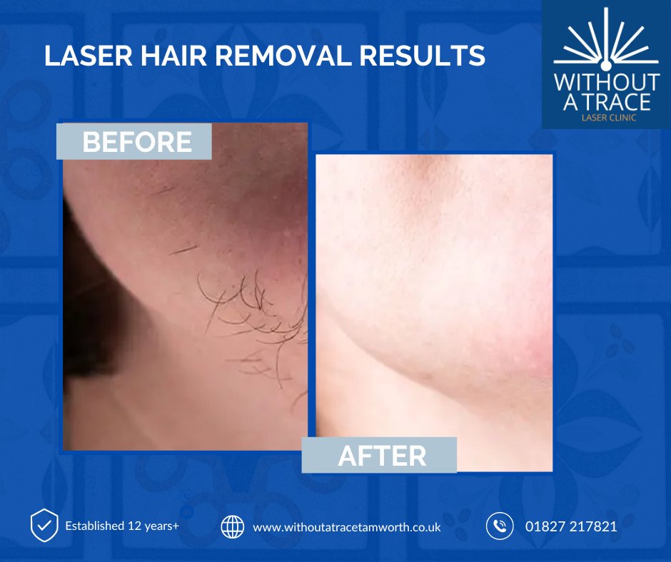 Unveil a new you with Laser Chin Hair Removal! 🌟 Say goodbye to unwanted hair / hello smooth, radiant skin. Check out these stunning before and after results. 😍 Ready for a change? Contact us for a free consultation today! 📞✨  01827 217821 #ChinHairRemoval #Transformation