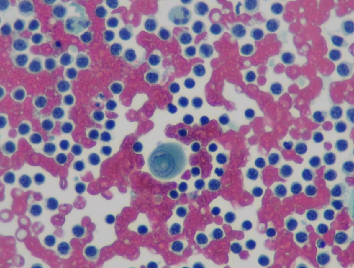 Small things matter. As @sza_jhcyto says, you can run but can't escape a cytopathologist's trained eyes. Papillary thyroid carcinoma in a lymph node #cytopath @SECitologia @CytologyEFCS