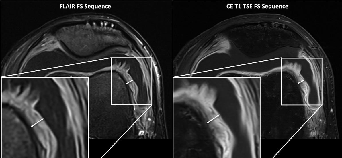 Can you replace iv-gadolinium for MSK imaging with AI? New #OpenAccess study 👉 doi.org/10.1097/RLI.00… DL-accelerated FLAIR sequence was equivalent for diagnosis of inflammatory #synovitis compared to T1-weighted contrast-enhanced #MRI @derbalgrist ǀ @SiemensHealth ǀ #MSKrad