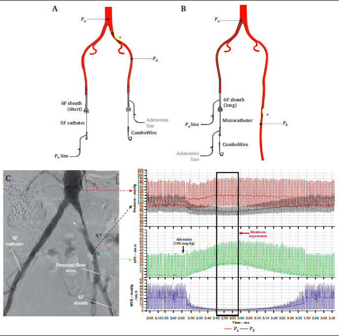 Don't miss this new #EJVESOA 'Intra-arterial Fractional Flow Reserve Measurements Provide an Objective Assessment of the Functional Significance of Peripheral Arterial Stenoses' @b_modarai #CLI #PAD

doi.org/10.1016/j.ejvs…