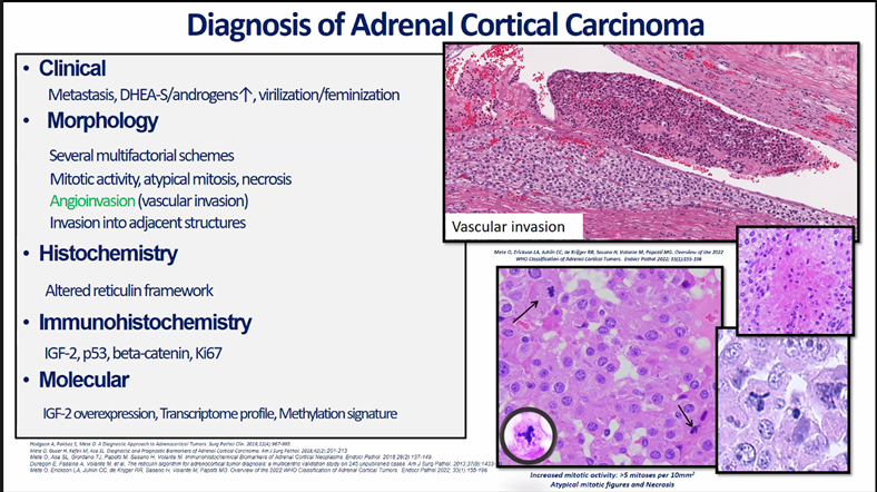 rovingatuscap's tweet image. Adrenal Neoplasia Pathology @GU_Path_Society
Virtual Education Session HAPPENING NOW!

Dr. Ozgur Mete @UofT_LMP presents:
2022 WHO Updates in Adrenal Pathology

@Shounak_Gupta @TretiakovaMaria 
#gupath #endopath