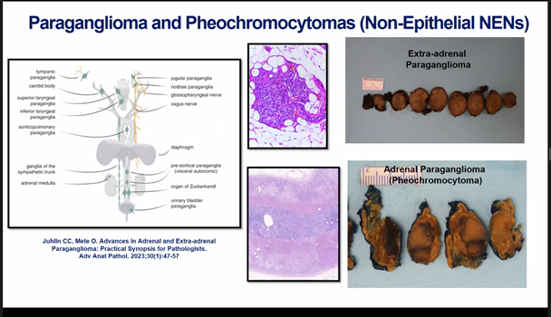 rovingatuscap's tweet image. Adrenal Neoplasia Pathology @GU_Path_Society
Virtual Education Session HAPPENING NOW!

Dr. Ozgur Mete @UofT_LMP presents:
2022 WHO Updates in Adrenal Pathology

@Shounak_Gupta @TretiakovaMaria 
#gupath #endopath