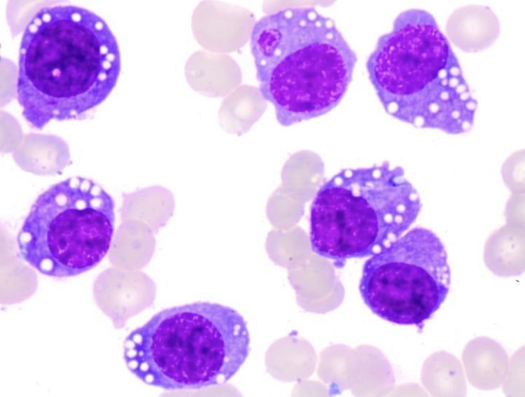 NicoGagelmann's tweet photo. Patient with acute kidney injury, severe anemia and edema. Diagnosis? https://t.co/xSyfkIAGNV