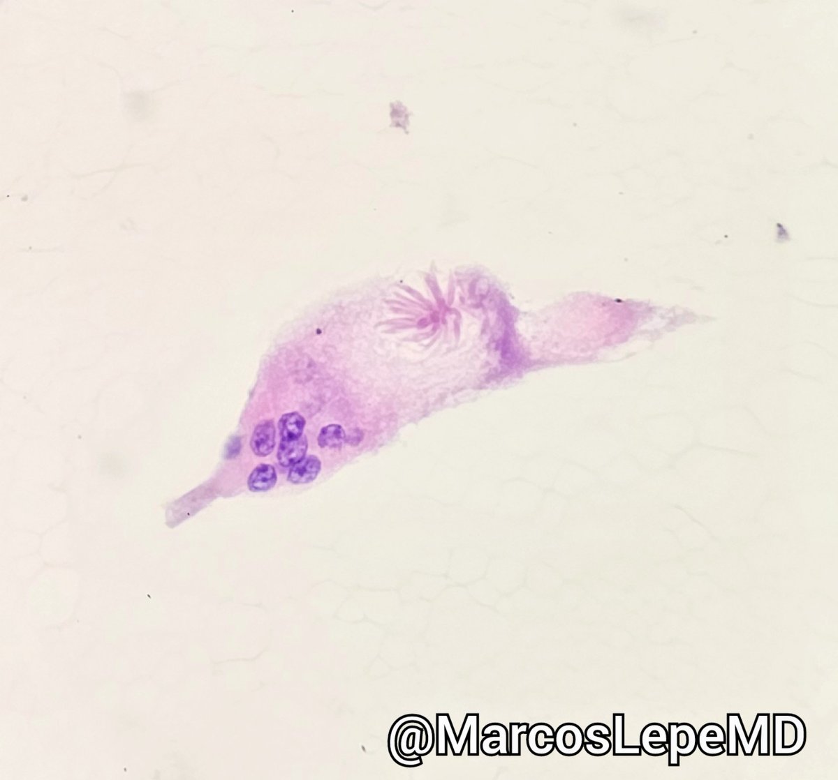 Let's see if I remember how to use Twitter/X: 💉Lymph node FNA Where was this lymph node (most likely) located? What cytologic finding is depicted? What is this associated with? #cytology #cytopathology