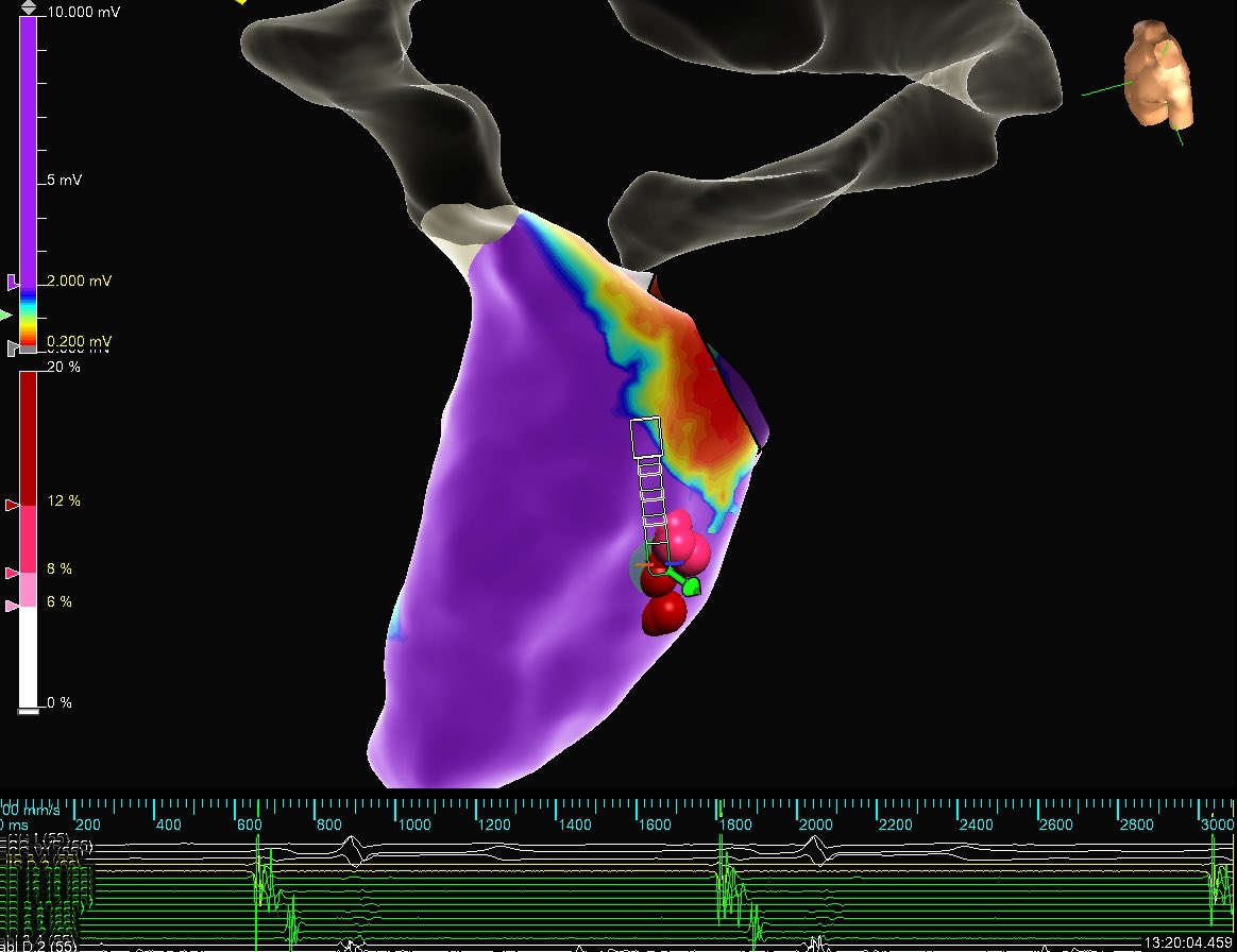theRhythmDocs's tweet photo. Satisfying PVC ablation in a post MVR pt. Utilized ViewMate Multi ICE imaging to locate area of scar under MVR. Early PVC timing &amp; unipole aligned with the same area. Note voltage map correlation with ICE image. 

EP: Dr. Sameer Satija
Map: @_JeanStein 

@AbbottCardio https://t.co/sdDhLo4lCX