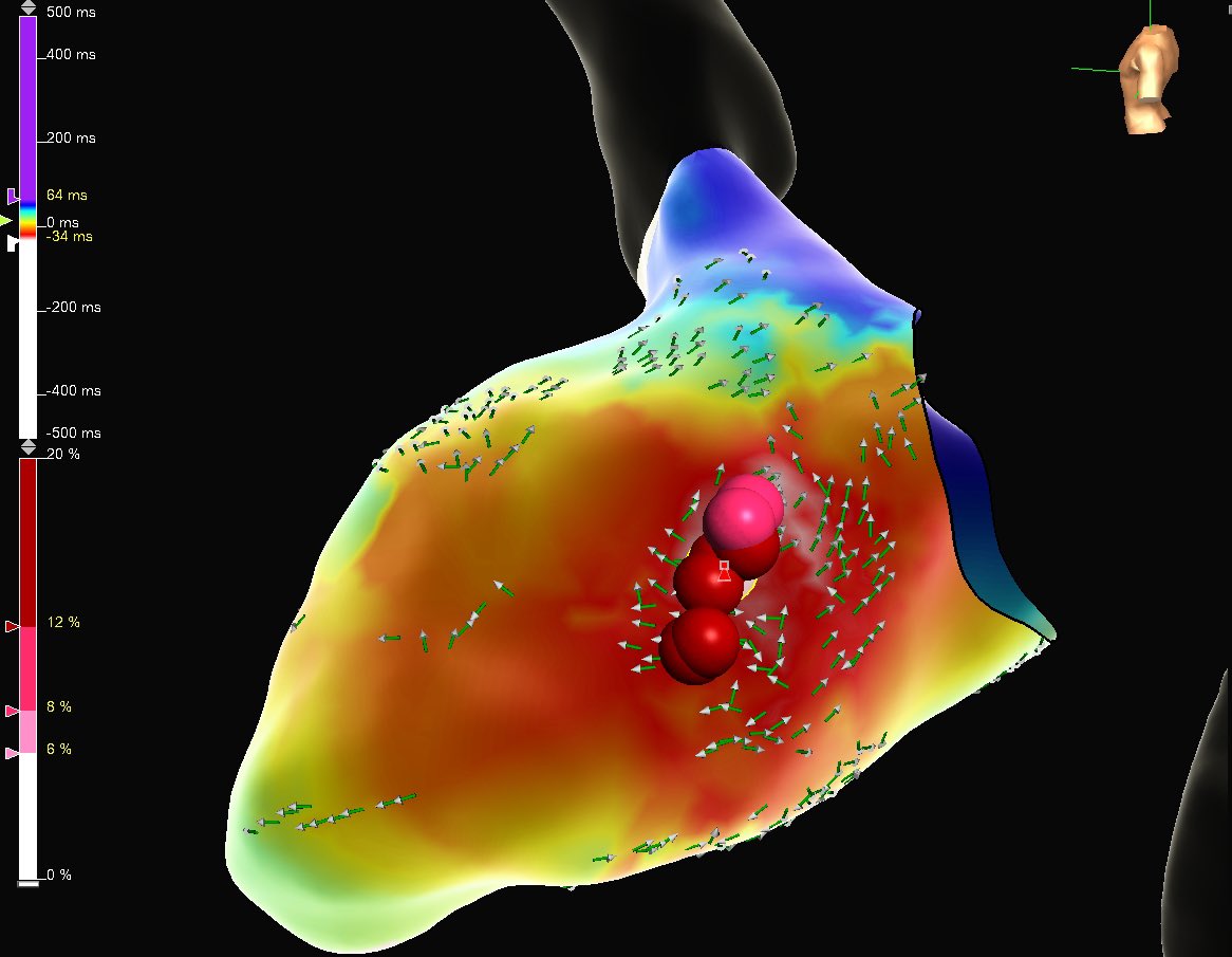 theRhythmDocs's tweet photo. Satisfying PVC ablation in a post MVR pt. Utilized ViewMate Multi ICE imaging to locate area of scar under MVR. Early PVC timing &amp; unipole aligned with the same area. Note voltage map correlation with ICE image. 

EP: Dr. Sameer Satija
Map: @_JeanStein 

@AbbottCardio https://t.co/sdDhLo4lCX