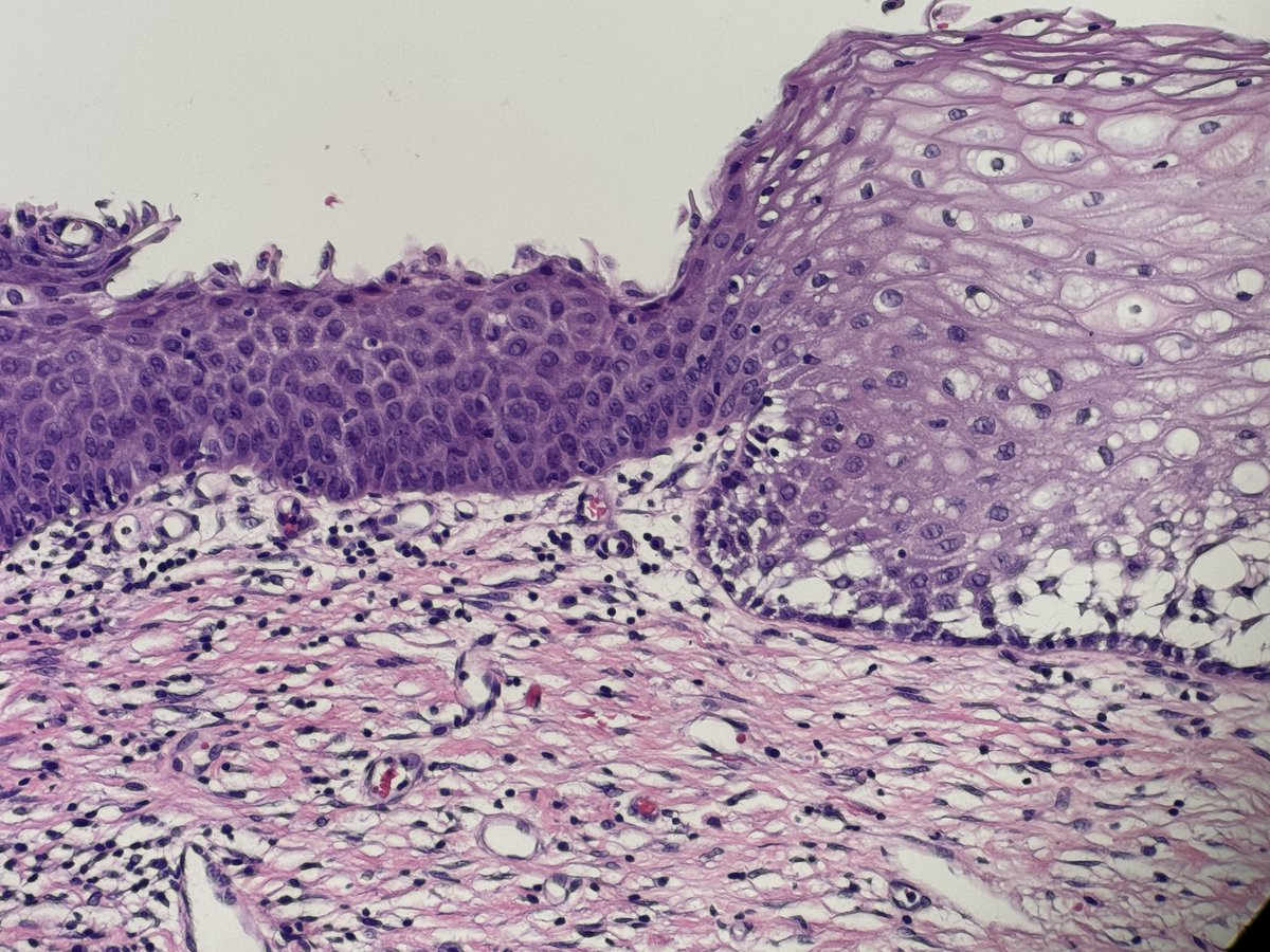 #Gynpath #Surgpath 48 y/o woman. Histerectomy for menorrhagia. Opinión of this area in the cervix ?