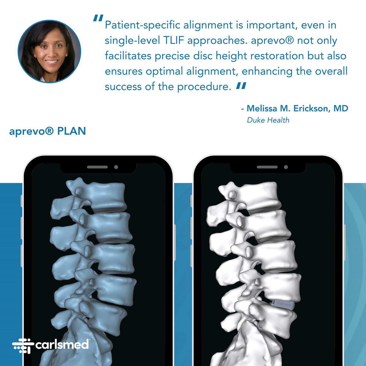carlsmed's tweet photo. Dr. Melissa Erickson at Duke University Hospital successfully achieved planned patient-specific alignment with a single-level oblique TLIF approach. 

#aprevo #Carlsmed #PersonalizedSurgery #GetYourPowerBack https://t.co/EmHh6RcFUg