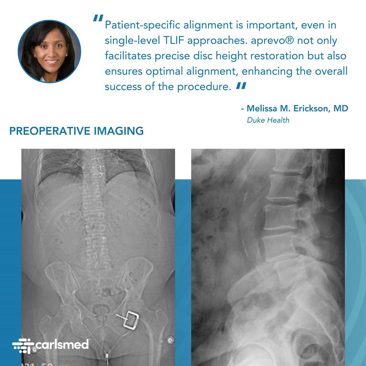 carlsmed's tweet photo. Dr. Melissa Erickson at Duke University Hospital successfully achieved planned patient-specific alignment with a single-level oblique TLIF approach. 

#aprevo #Carlsmed #PersonalizedSurgery #GetYourPowerBack https://t.co/EmHh6RcFUg