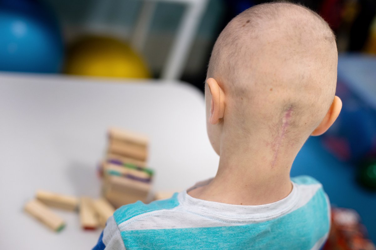 Posterior fossa syndrome (PFS) develops in over 40% of kids with medulloblastoma. The Rotterdam Model, a scoring system said to predict incidences of PFS, was tested on eligible #SJMB12 patients post-op. Read the new @TheJNS paper: tinyurl.com/4nm7bekb @KlimoJr