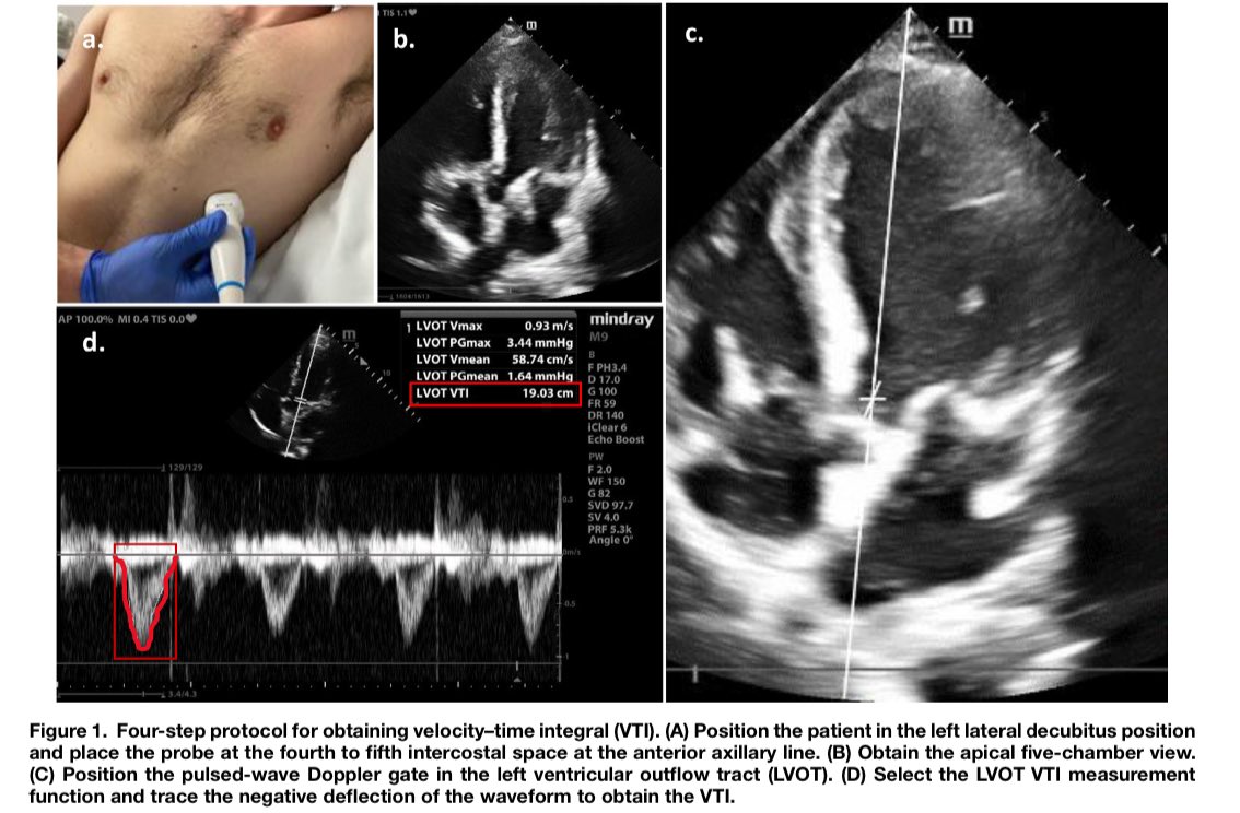 🌟 ¡Como Medir el #IVT en Urgencias en 4 Pasos Fáciles! 🚨 En este HILO te explicamos como 🧵✅
👇🏼                 👇🏼                  👇🏼

1️⃣ #Configuración y #Posicionamiento Inicial 🛠️👤📍

   - Primero que tu ecógrafo sea compatible 🖥️✨, como el Mindray M9.
   - Coloca al