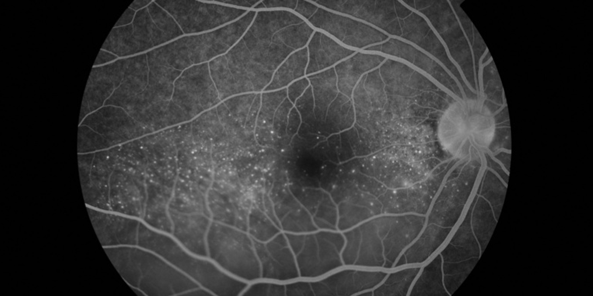 eyewiki's tweet photo. #Fluoresceinangiography is useful in the diagnosis of #VKH, showing multifocal pinpoint leakage and pooling of fluid in the subretinal space in the late stage. #ophthalmology #retina https://t.co/cCSJ2AkvFC https://t.co/8GQZoshoUw