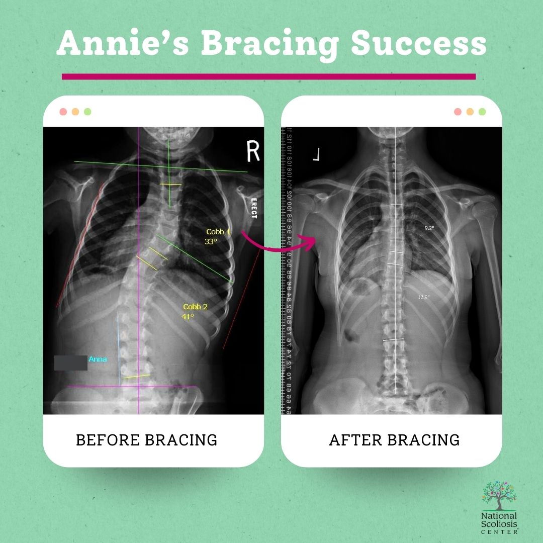 NScoliosisC's tweet photo. 🌟 Big News! 🌟 Annie has officially completed her bracing journey! 🎉 We couldn't be prouder of you, Annie! Keep shining bright! 💪💚
#ScoliosisWarrior #BraceGraduate #NoSurgeryNeeded #scoliosis #scoliosisbrace #rigocheneaubrace #scoliosisawareness #nationalscoliosiscenter https://t.co/mf23nDck3m