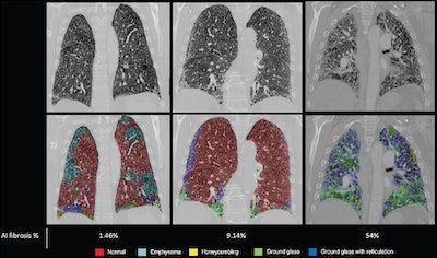 AuntMinnie's tweet image. AI boosts CTPA&apos;s ability to predict lung disease survival #ImagingAI #radiology bit.ly/3HRMSIz