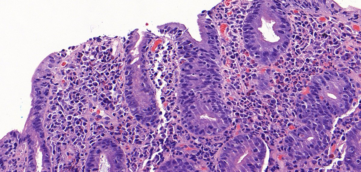 TristanRutland7's tweet photo. 🔬Small bowel, older adult

⚕️Presents with ~3 months of chronic non-bloody diarrhoea and weight loss.

✏️Provided history: Diarrhoea

#MedTwitter #pathtwitter #GIpath #pathresidents https://t.co/YY3HnWo1d0